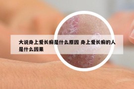 大說身上愛長癬是什么原因 身上愛長癬的人是什么因果