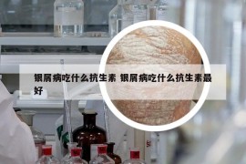 銀屑病吃什么抗生素 銀屑病吃什么抗生素最好
