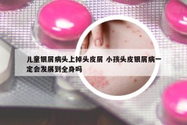 兒童銀屑病頭上掉頭皮屑 小孩頭皮銀屑病一定會發(fā)展到全身嗎
