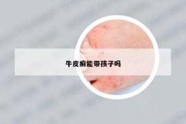 牛皮癬能帶孩子嗎