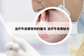 治療牛皮癬有效的偏方 治療牛皮癬秘方