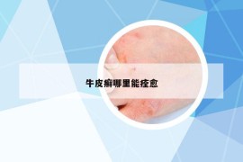 牛皮癬哪里能痊愈