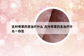 古村奇草藥膏治療什么 古村奇草藥膏治療什么一白左