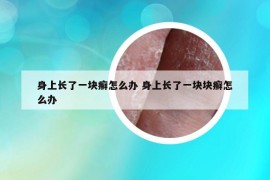 身上長了一塊癬怎么辦 身上長了一塊塊癬怎么辦