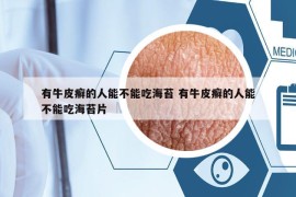 有牛皮癬的人能不能吃海苔 有牛皮癬的人能不能吃海苔片