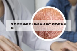 血熱型銀屑病怎么通過手術(shù)治療 血熱性銀屑病