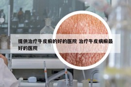 提供治療牛皮癬的好的醫(yī)院 治療牛皮病癬最好的醫(yī)院