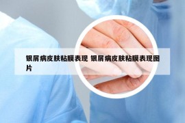 銀屑病皮膚粘膜表現(xiàn) 銀屑病皮膚粘膜表現(xiàn)圖片