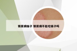 銀屑病柚子 銀屑病不能吃橘子嗎