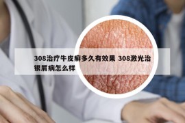 308治療牛皮癬多久有效果 308激光治銀屑病怎么樣