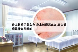 身上長(zhǎng)癬了怎么辦 身上長(zhǎng)癬怎么辦,身上長(zhǎng)癬是什么引起的