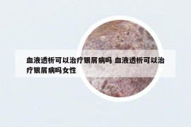 血液透析可以治療銀屑病嗎 血液透析可以治療銀屑病嗎女性