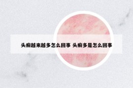 頭癬越來越多怎么回事 頭癬多是怎么回事