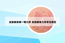 皮膚癬有哪一哪幾種 皮膚癬有幾種常見類型