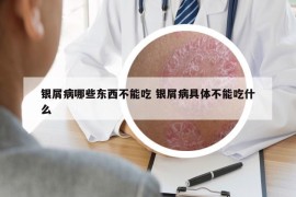 銀屑病哪些東西不能吃 銀屑病具體不能吃什么