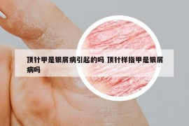 頂針甲是銀屑病引起的嗎 頂針樣指甲是銀屑病嗎