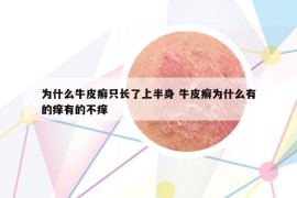 為什么牛皮癬只長(zhǎng)了上半身 牛皮癬為什么有的癢有的不癢