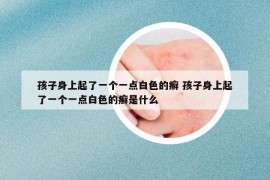 孩子身上起了一個(gè)一點(diǎn)白色的癬 孩子身上起了一個(gè)一點(diǎn)白色的癬是什么