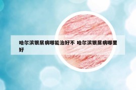 哈爾濱銀屑病哪能治好不 哈爾濱銀屑病哪里好