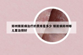 鄭州銀屑病治療的費用是多少 銀屑病鄭州哪兒里治得好