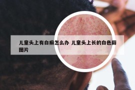 兒童頭上有白癬怎么辦 兒童頭上長(zhǎng)的白色蘚圖片