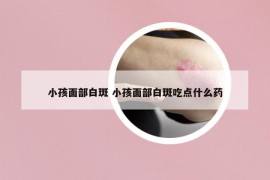 小孩面部白斑 小孩面部白斑吃點(diǎn)什么藥