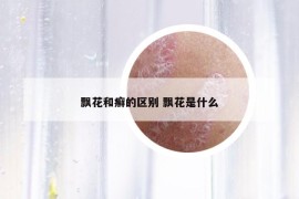 飄花和癬的區(qū)別 飄花是什么