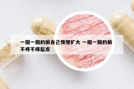 一圈一圈的癬自己慢慢擴大 一圈一圈的癬 不疼不癢起皮