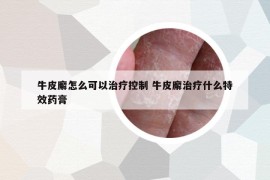 牛皮廨怎么可以治療控制 牛皮廨治療什么特效藥膏