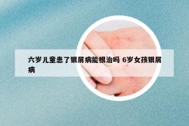 六歲兒童患了銀屑病能根治嗎 6歲女孩銀屑病
