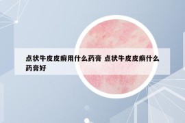 點(diǎn)狀牛皮皮癬用什么藥膏 點(diǎn)狀牛皮皮癬什么藥膏好