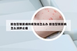 膿包型銀屑病持續(xù)發(fā)燒怎么辦 膿包型銀屑病怎么消腫止痛