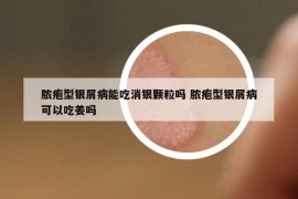膿皰型銀屑病能吃消銀顆粒嗎 膿皰型銀屑病可以吃姜嗎