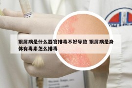 銀屑病是什么器官排毒不好導致 銀屑病是身體有毒素怎么排毒