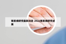 銀屑病研究最新動態(tài) 2021銀屑病研究進展