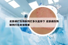皮膚病打生物制劑打多久能停下 皮膚病生物制劑打在身體哪里
