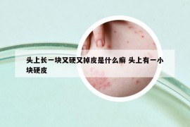 頭上長一塊又硬又掉皮是什么癬 頭上有一小塊硬皮