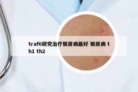 traf6研究治療銀屑病最好 銀屑病 th1 th2