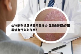 生物制劑銀屑病費用是多少 生物制劑治療銀屑病有什么副作用?