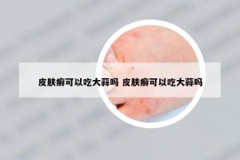 皮膚癬可以吃大蒜嗎 皮膚癬可以吃大蒜嗎