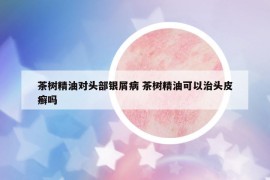 茶樹精油對(duì)頭部銀屑病 茶樹精油可以治頭皮癬嗎