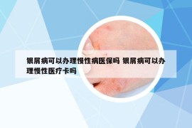 銀屑病可以辦理慢性病醫(yī)保嗎 銀屑病可以辦理慢性醫(yī)療卡嗎
