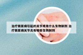 治療銀屑病引起的關(guān)節(jié)疼用什么生物制劑 治療銀屑病關(guān)節(jié)炎有哪些生物制劑