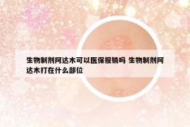 生物制劑阿達(dá)木可以醫(yī)保報銷嗎 生物制劑阿達(dá)木打在什么部位