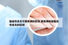 酯益性皮炎與銀屑病的區(qū)別 銀屑病和益脂溢性皮炎的區(qū)別