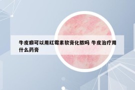 牛皮癖可以用紅霉素軟膏化膿嗎 牛皮治療用什么藥膏