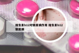 維生素b12對銀屑病作用 維生素b12 銀屑病