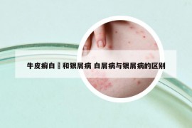 牛皮癬白疕和銀屑病 白屑病與銀屑病的區(qū)別