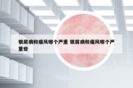 銀屑病和痛風(fēng)哪個嚴重 銀屑病和痛風(fēng)哪個嚴重些
