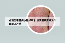 點(diǎn)滴型銀屑病小腿好不了 點(diǎn)滴型銀屑病為什么腿上嚴(yán)重